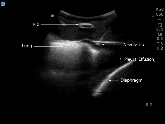 Ultrasound Guided Needle Procedures